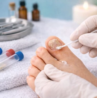 Imagem Tratamento para Micose de Unha (Onicomicose)